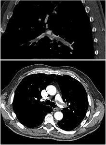 VTE Prophylaxis(图2)