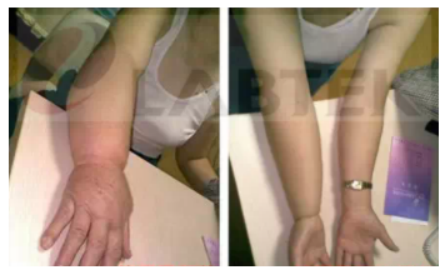 Lymphedema Of The Right Arm After Breast Surgery(图1)