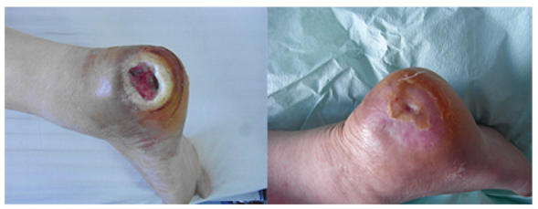 Diabetic Foot(图1)