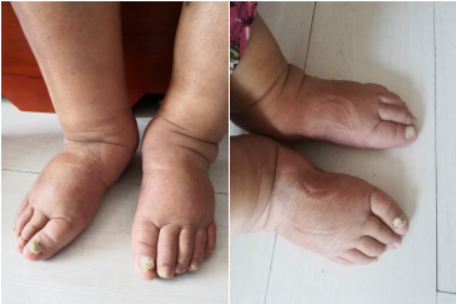 Limb Edema Caused By Poor Blood Circulation(图1)