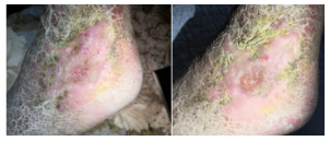 Rotten-Leg Disease(图1)
