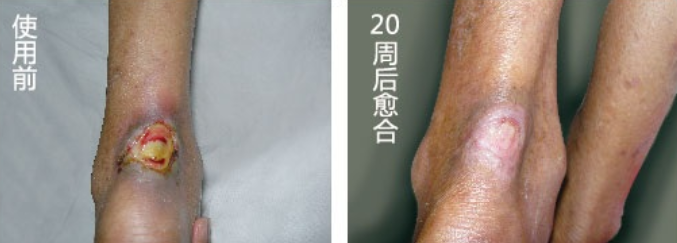 李某，右下肢深静脉功能不全(图1)