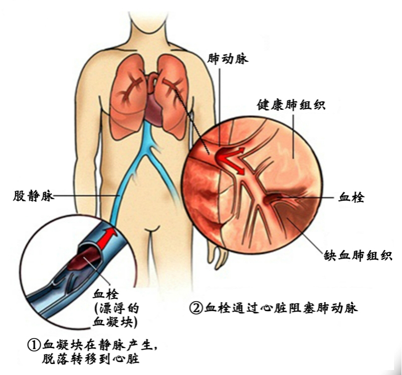 深静脉血栓预防(图1)