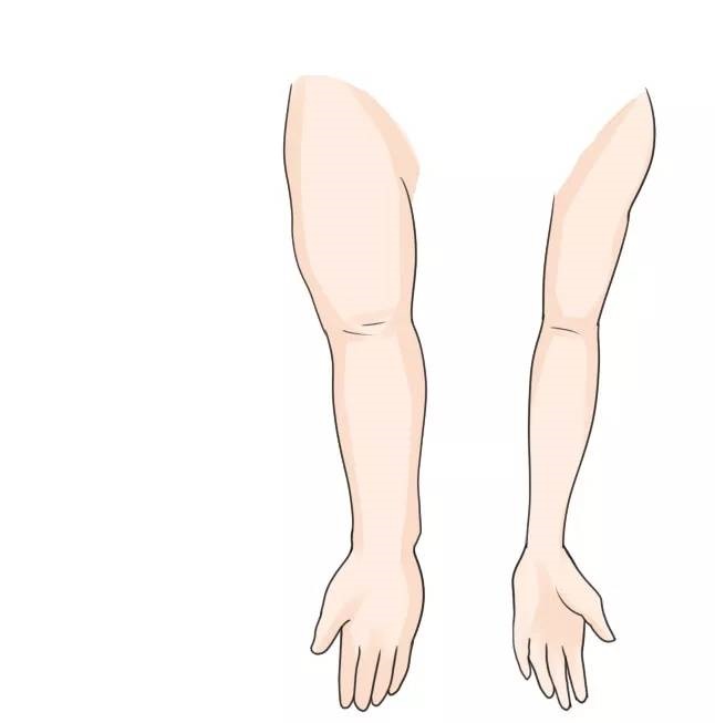 急性慢水肿(图3)
